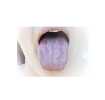 Clinical appearance of a geographic tongue